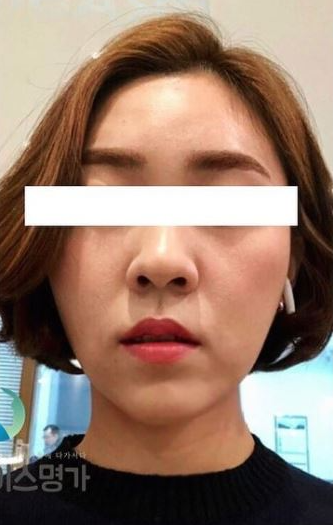 CASE 02 시술 후